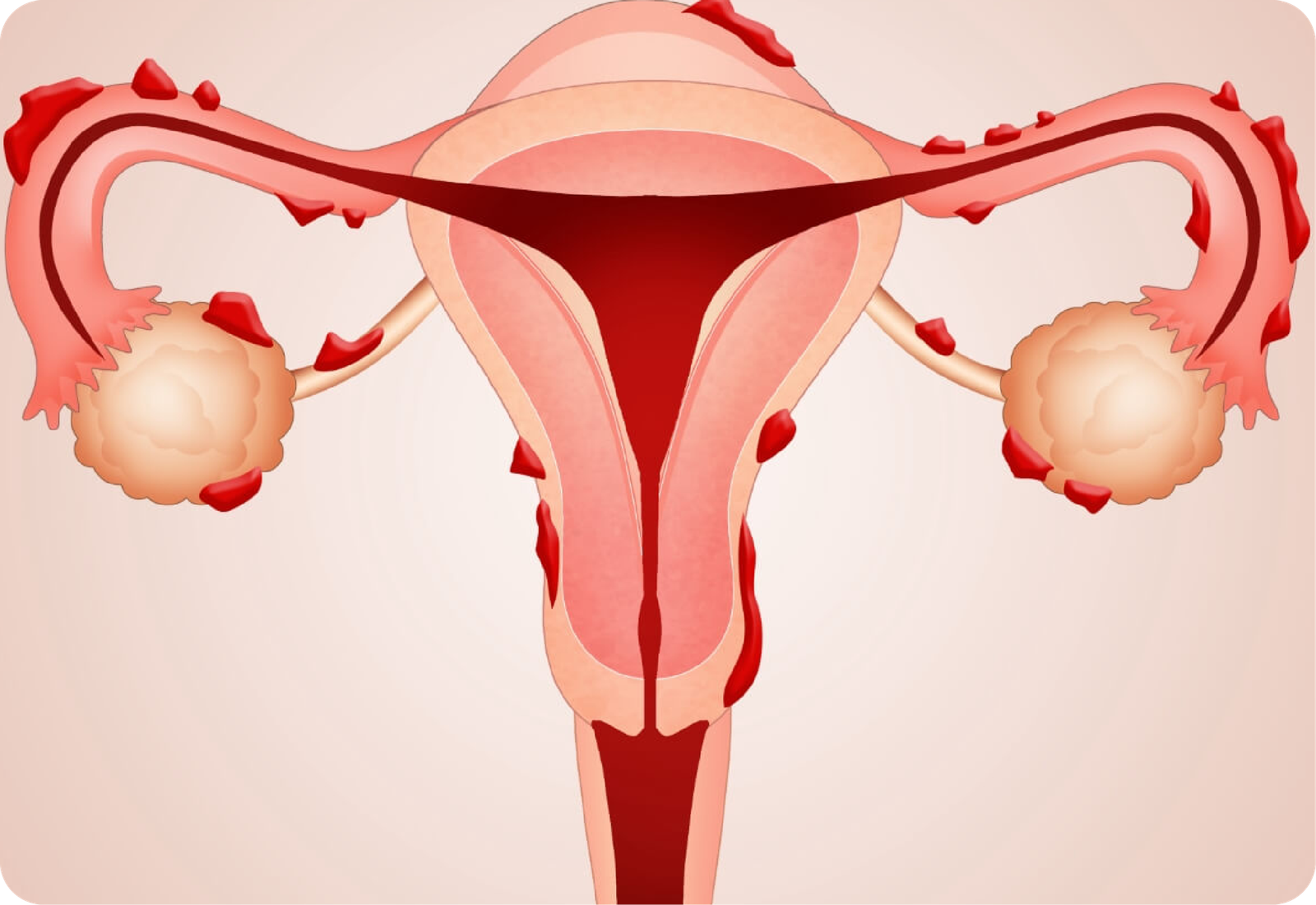 Endometriosis Excision